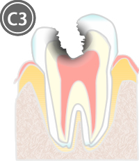 歯髄に達した虫歯