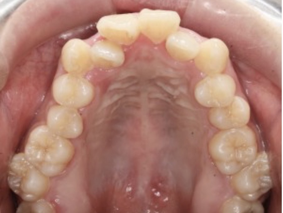 発達期の低位舌が原因の歯列不正