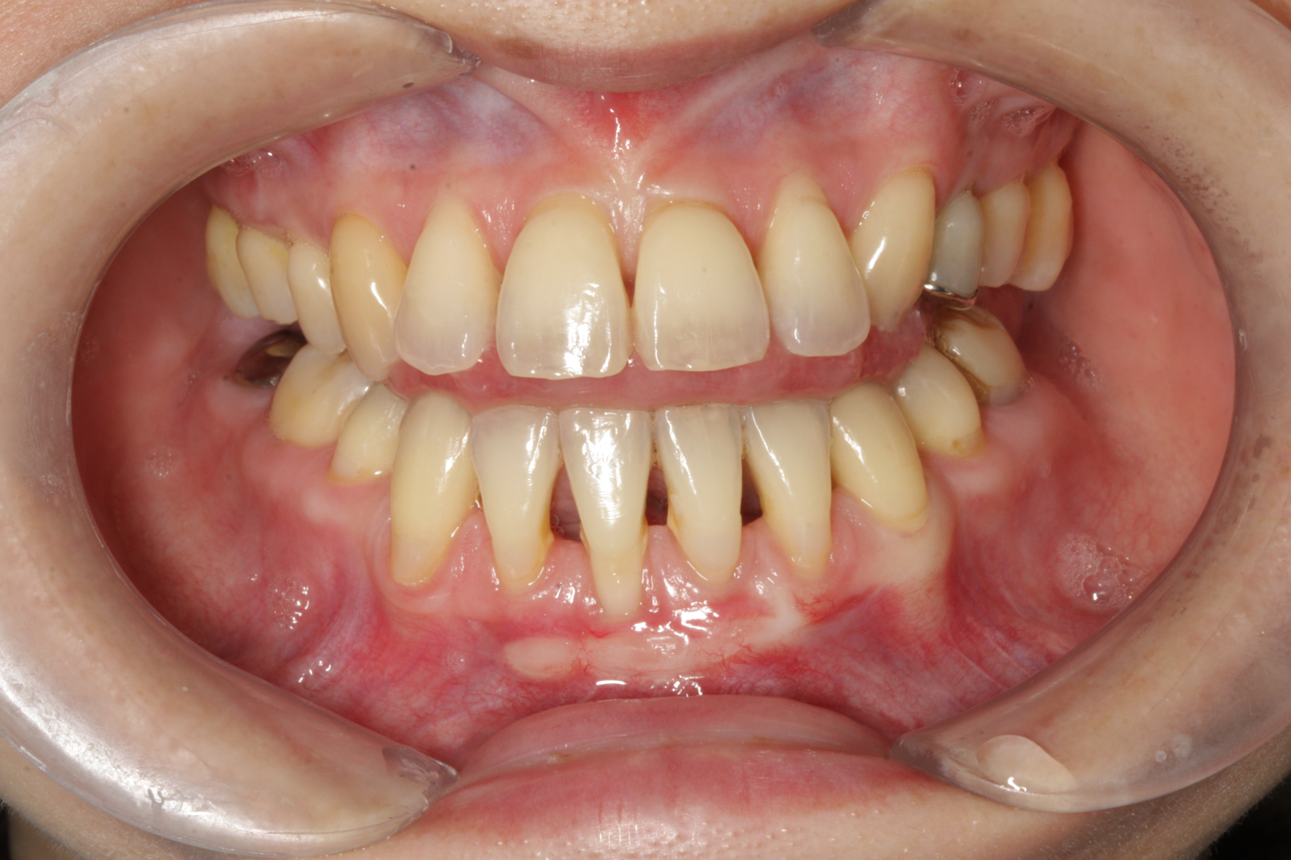 歯肉が下がった場合の再生治療も可能です